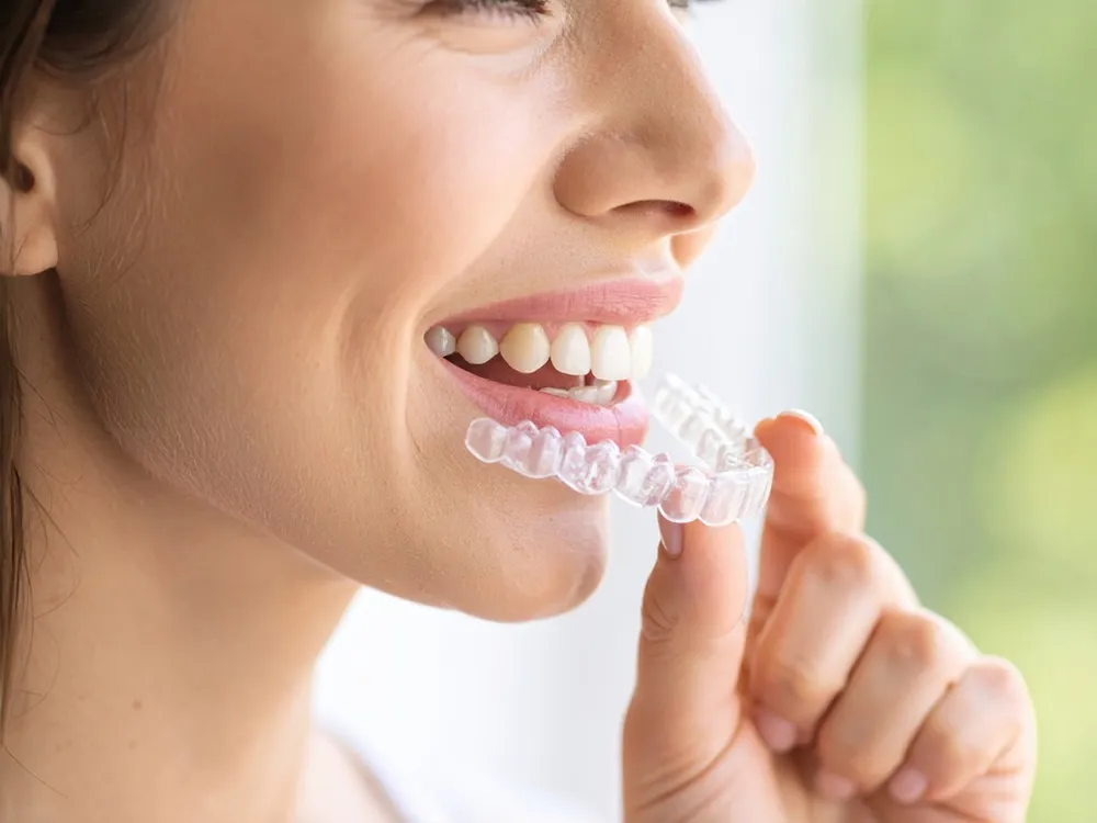 Gouttières Invisalign® transparentes — orthodontie invisible amovible adulte Suisse romande